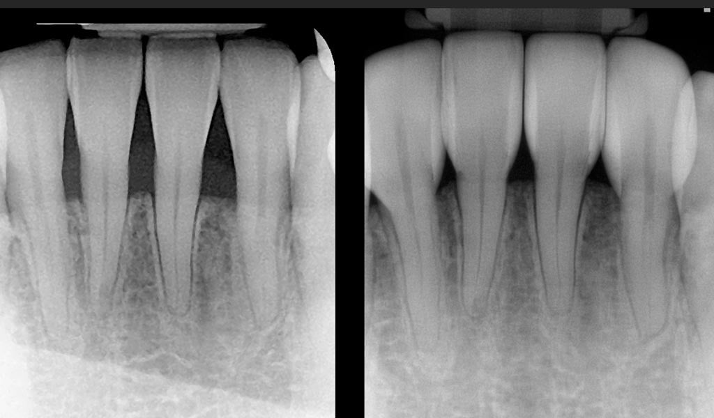 How Bioclear Empowers Dentists To Treat Black Triangles Optident